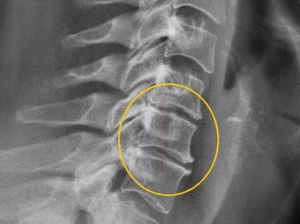 Osteochondroza kręgosłupa szyjnego na x -na
