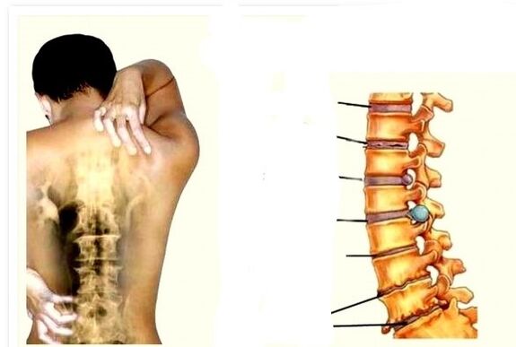 Osteochondroza jest przyczyną bólu pleców